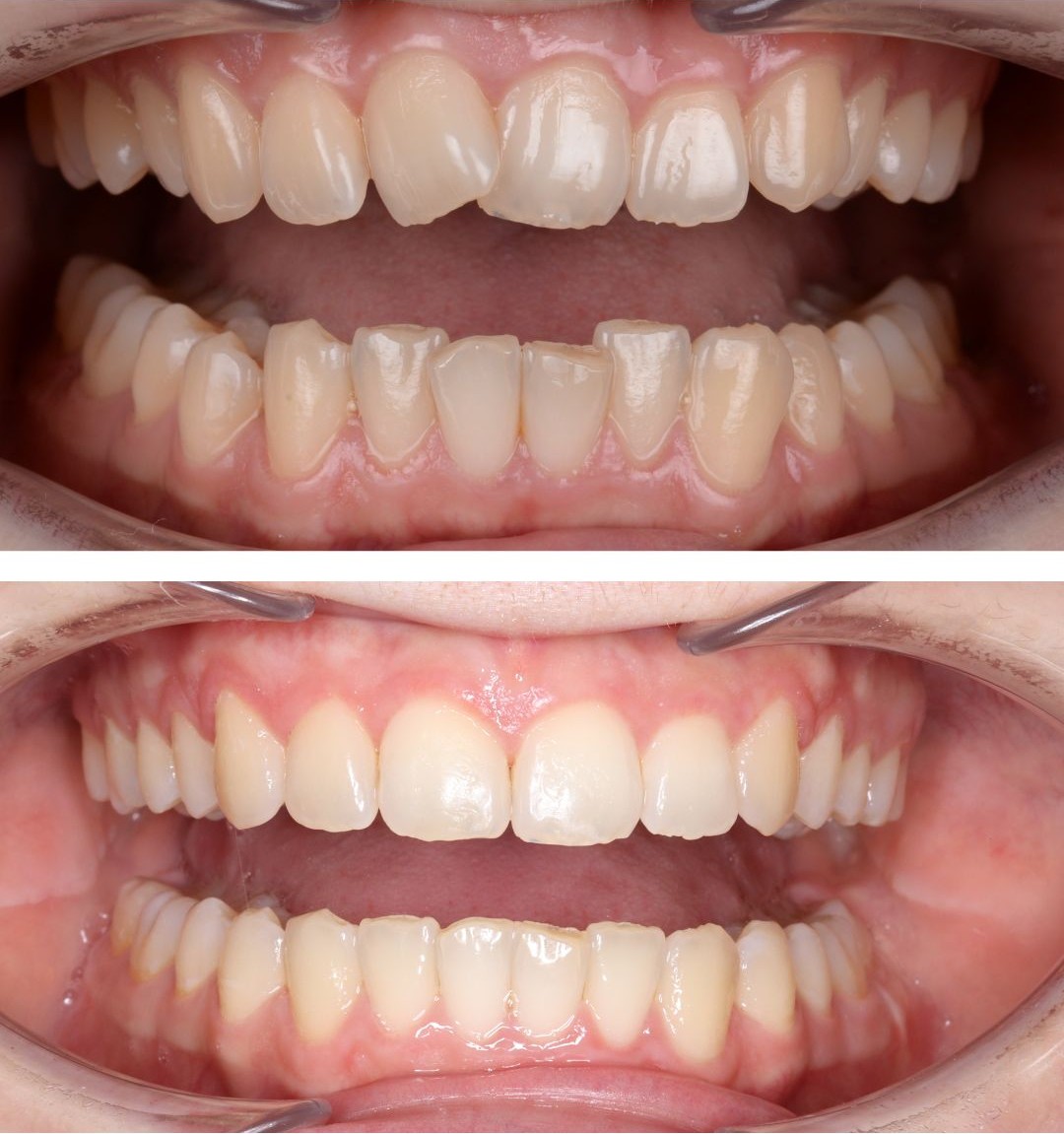 Aligner Behandlung Schritte