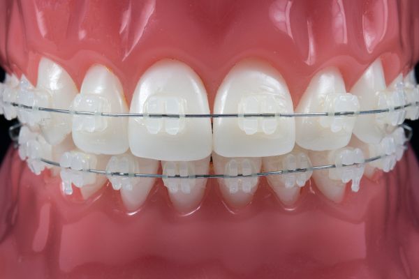 Keramikbrackets